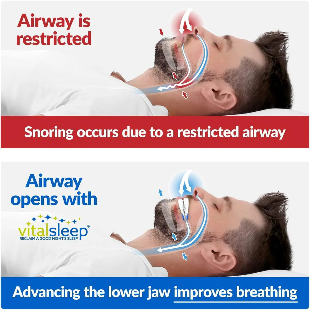VitalSleep Personalized Anti-Snoring Mouthpiece